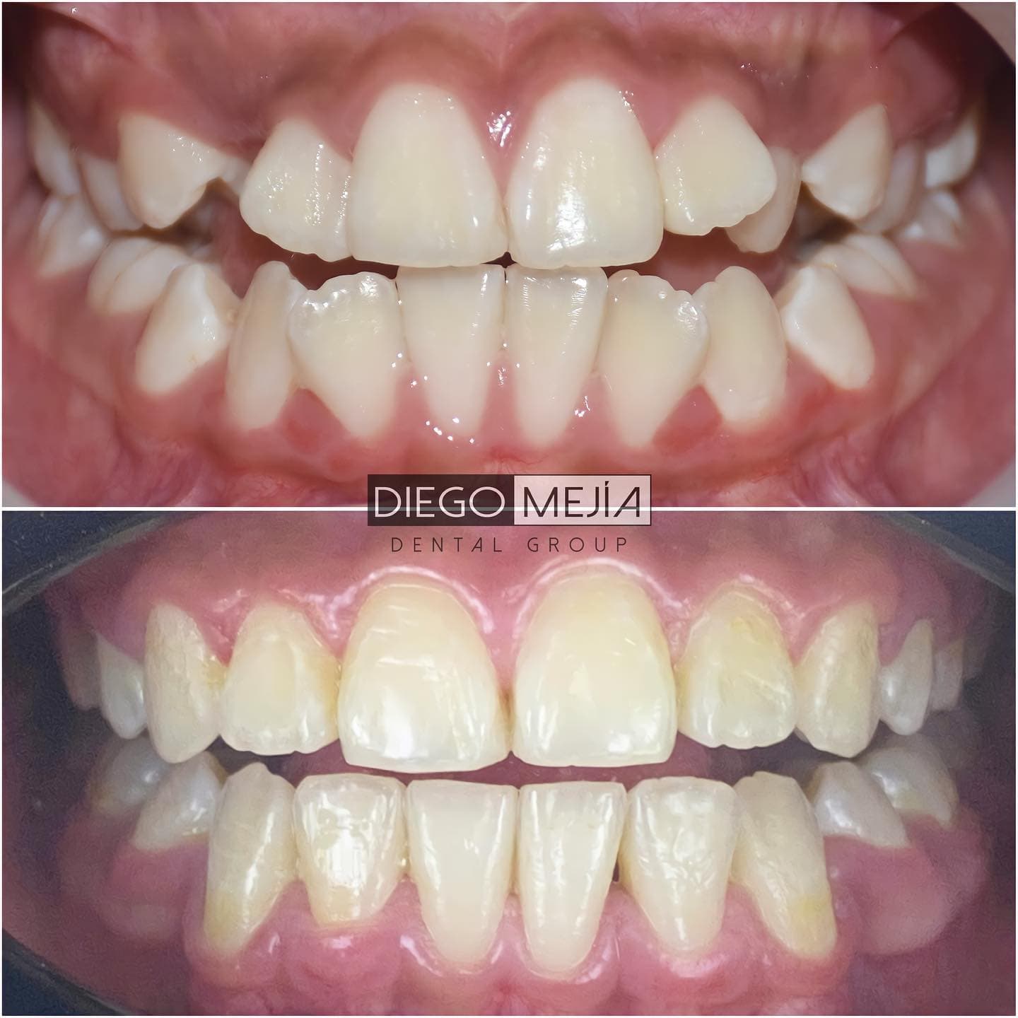 Antes y después de ortodoncia sin brackets con Invisalign