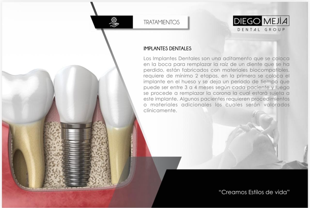 Implantes dentales