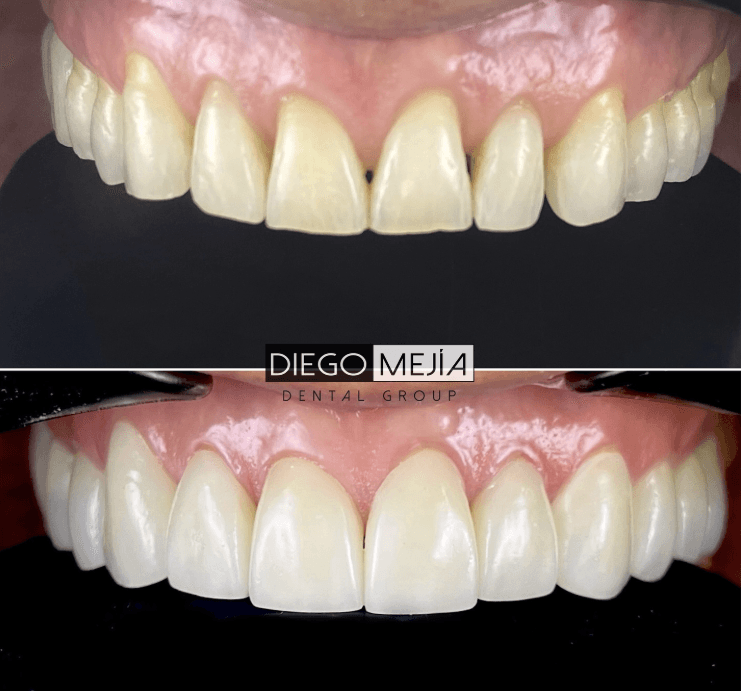 Mini diseño de sonrisa