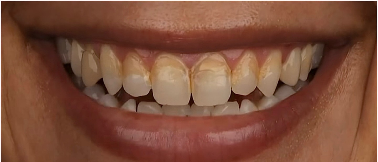 Antes de carillas dentales cerámicas