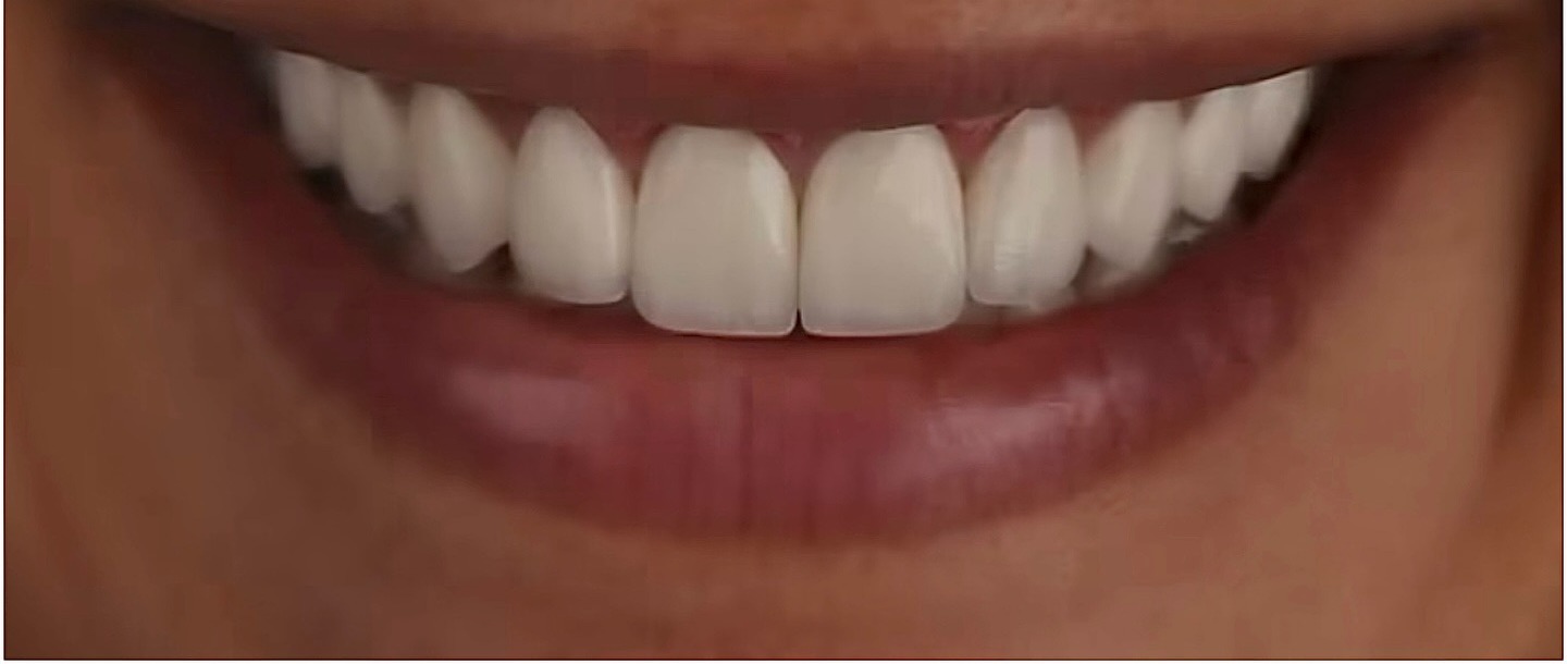 Después de carillas dentales cerámicas, sonrisa natural