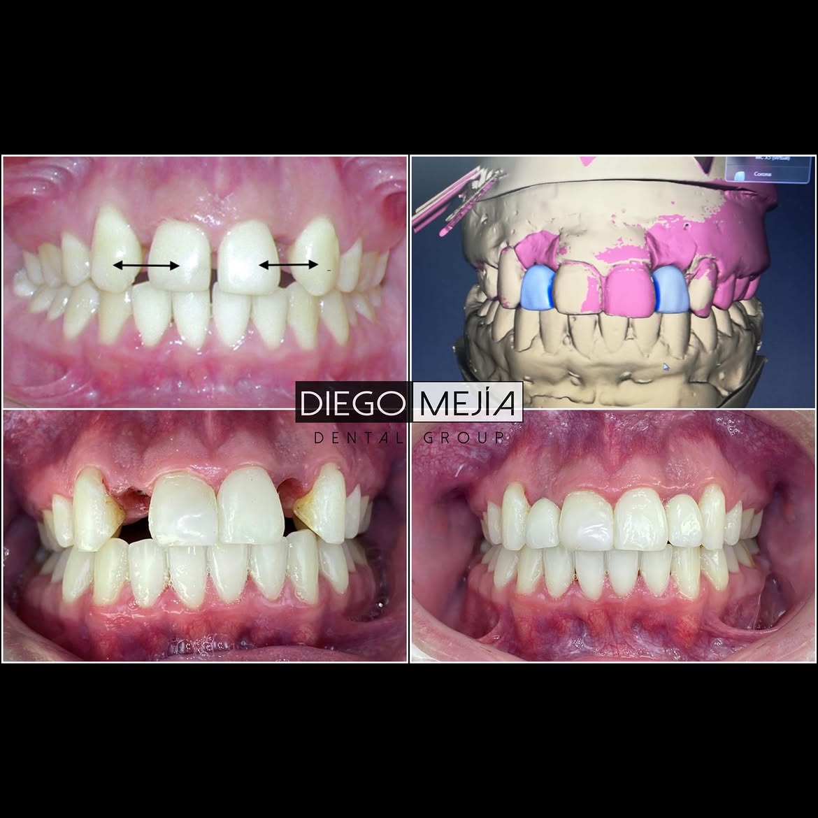 Caso implante dental y ortodoncia con planeación digital