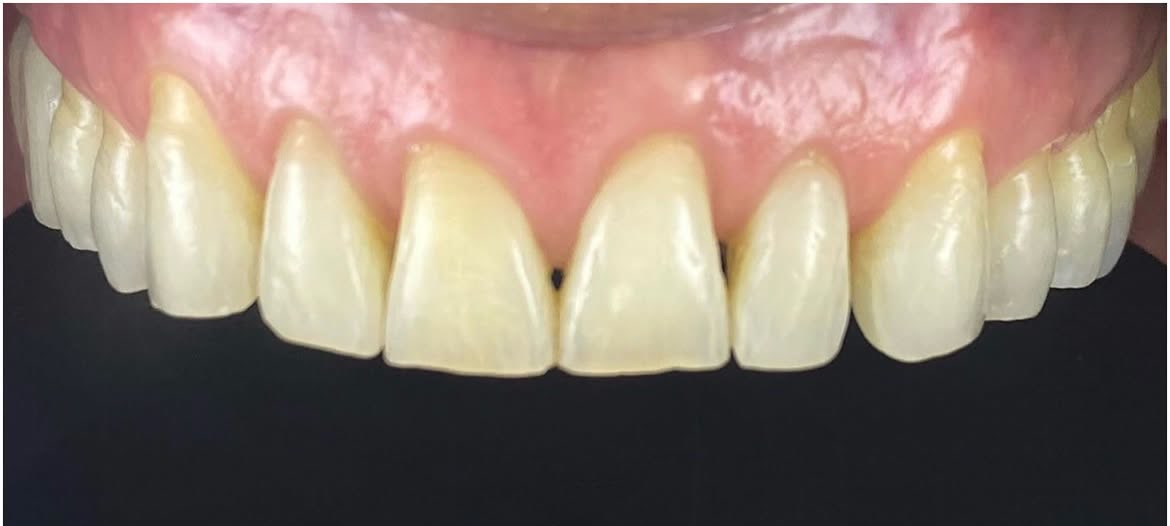 Antes de lentes de contacto dental cerámicos