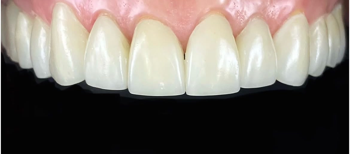 Después de lentes de contacto dental cerámicos
