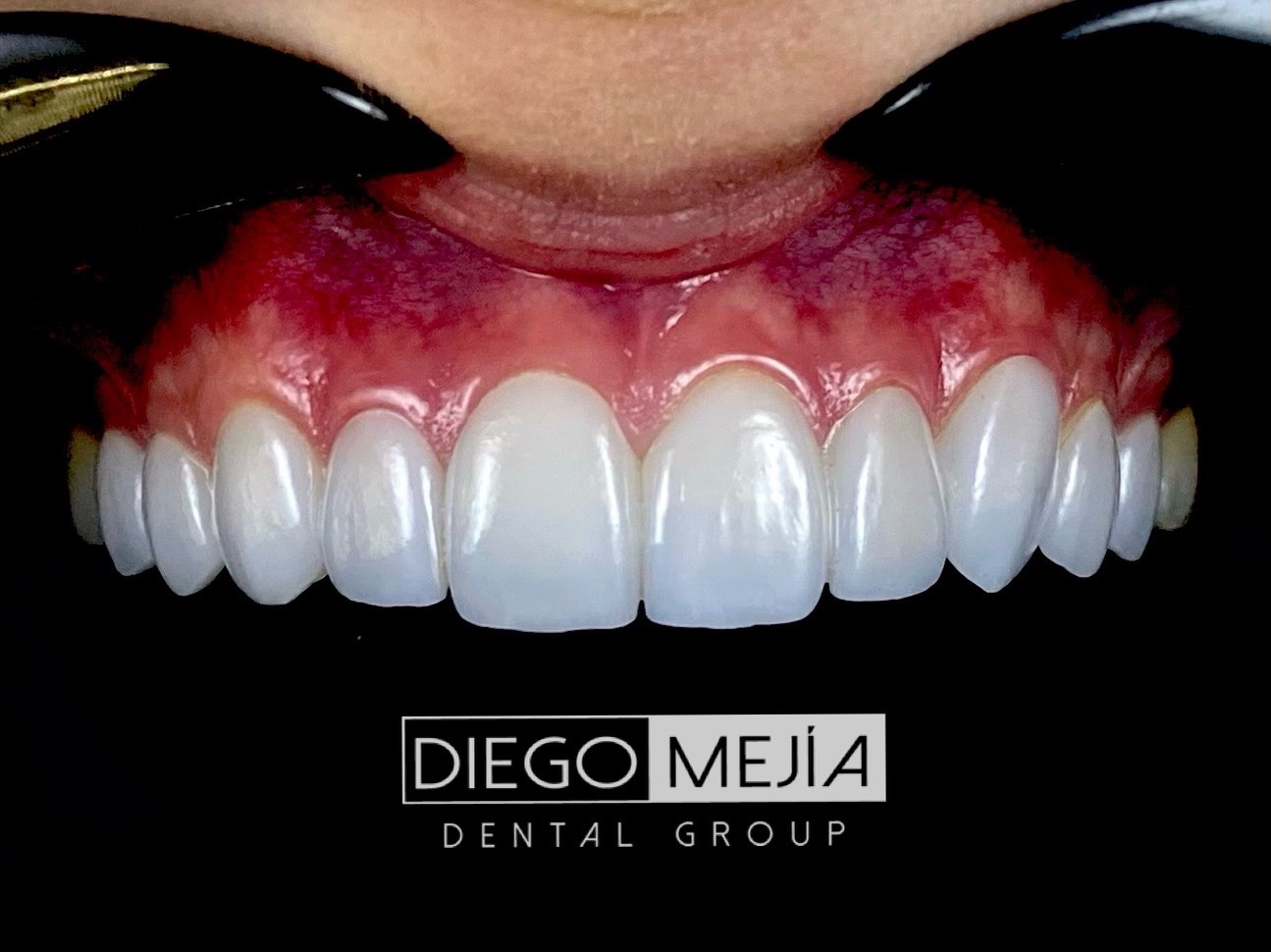 Laminados cerámicos dentales de alta estética