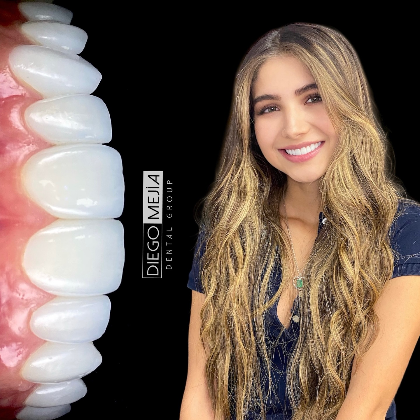 Resultado de diseño de sonrisa, paciente Shaira